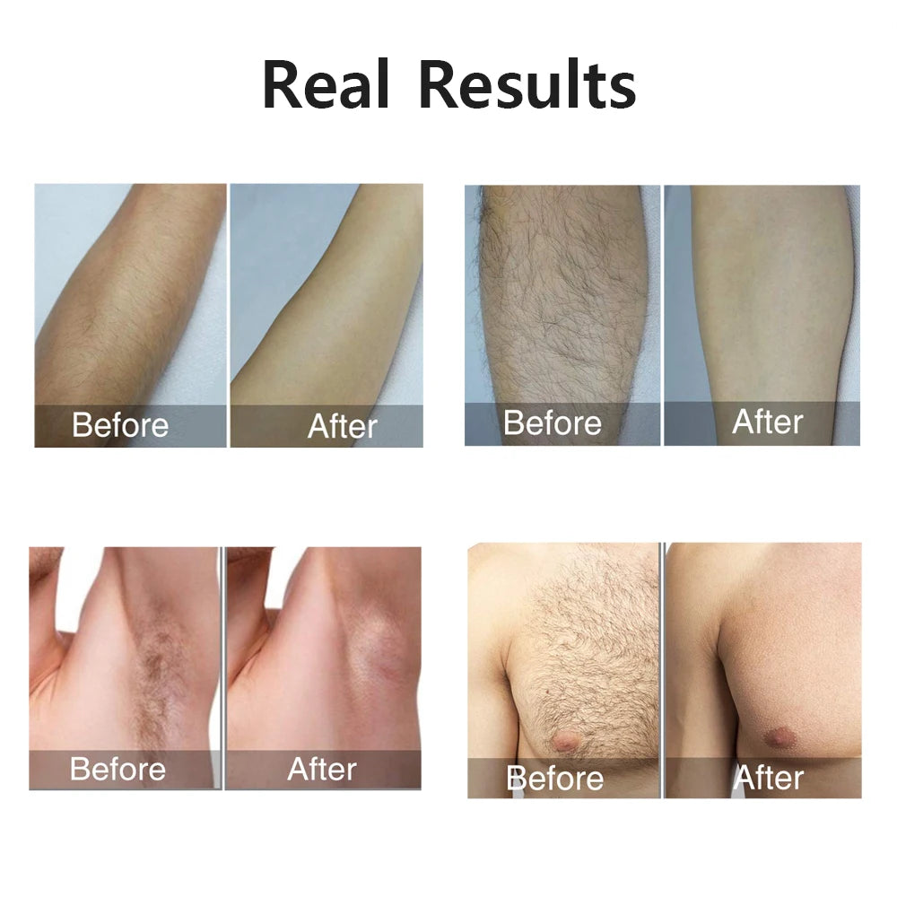 999999 Flashes IPL Laser Hair Removal Device for Women and Men - Painless Permanent Epilator for Body, Bikini, Legs, Arms, and Underarms